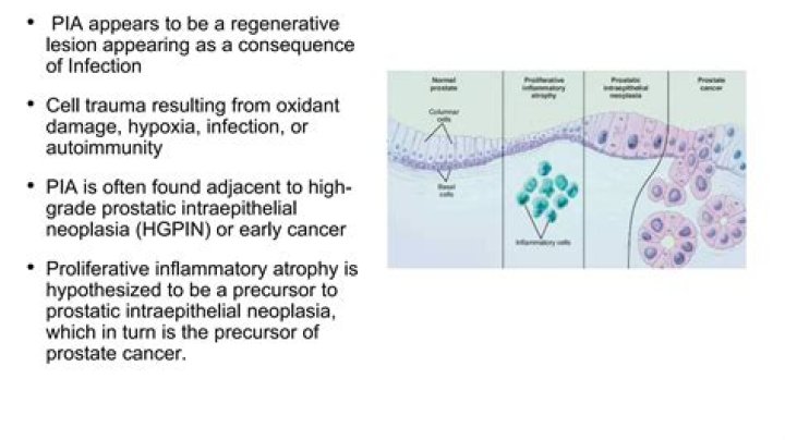 Is HGPIN a cancer?